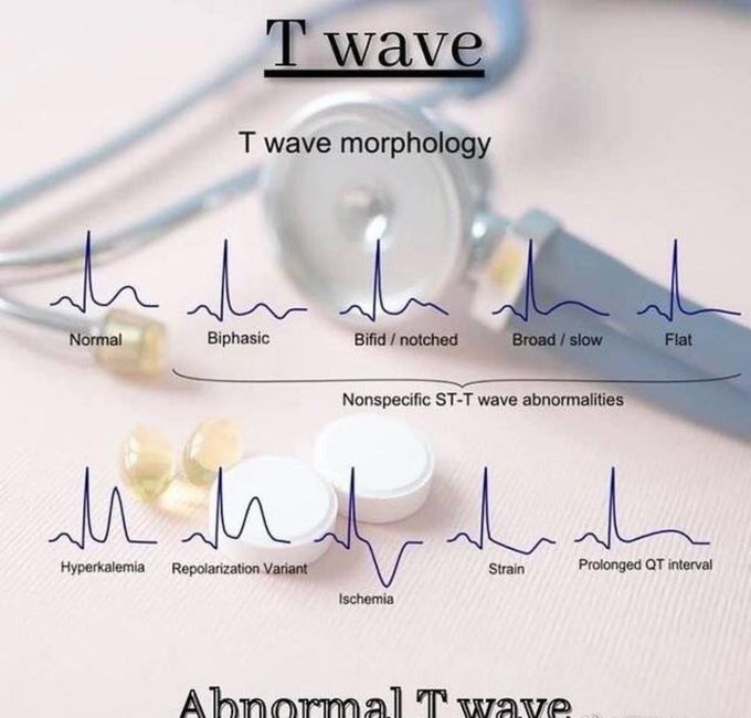 Abnormal T wave