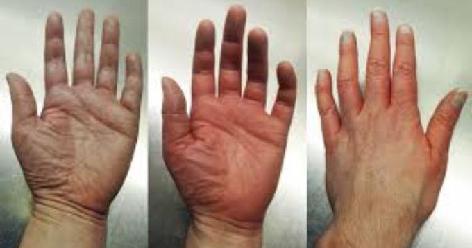 Erythromelalgia (EM)