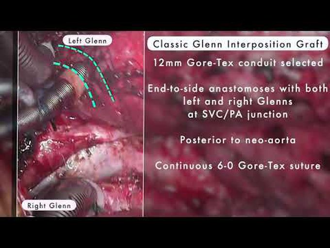 Posterolateral Tunnel Fontan, Bilateral Classic Glenn Centralization