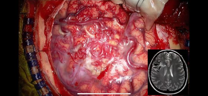 Cranial AVM (Arteriovenous malformation)!