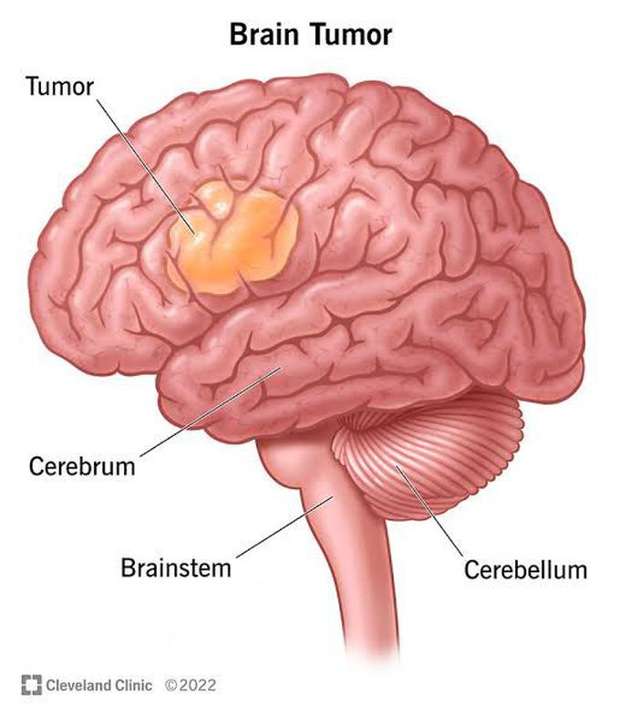 Brain tumor & its symptoms