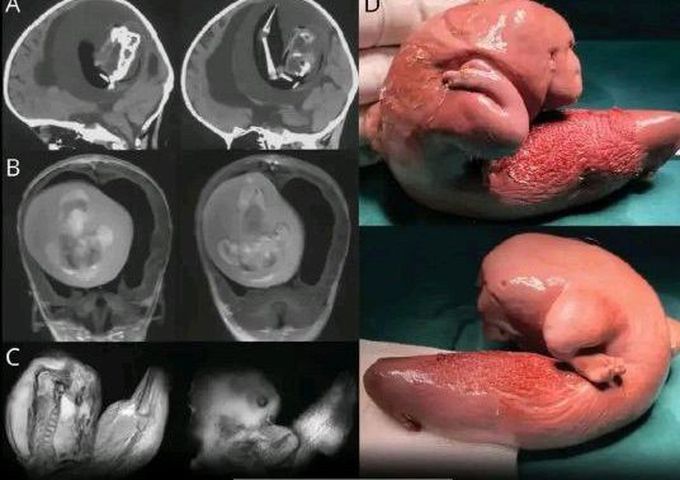 A human foetus was removed from brain of a one year old girl