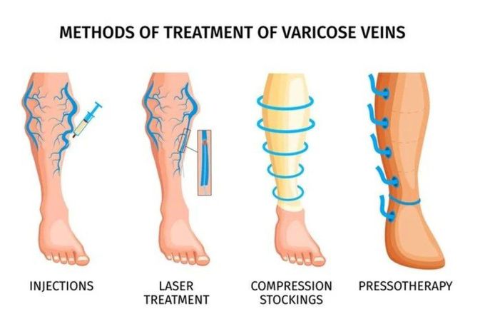 Varicose Veins - Treatment
