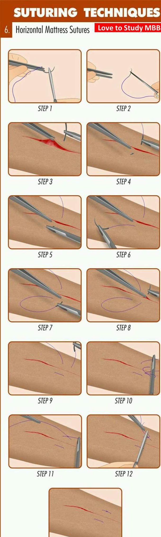 Suture technique