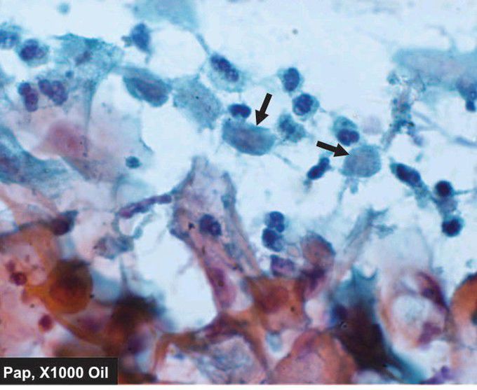 Trichomonas smear