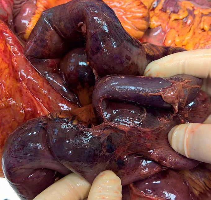 Intestinal Ischemia