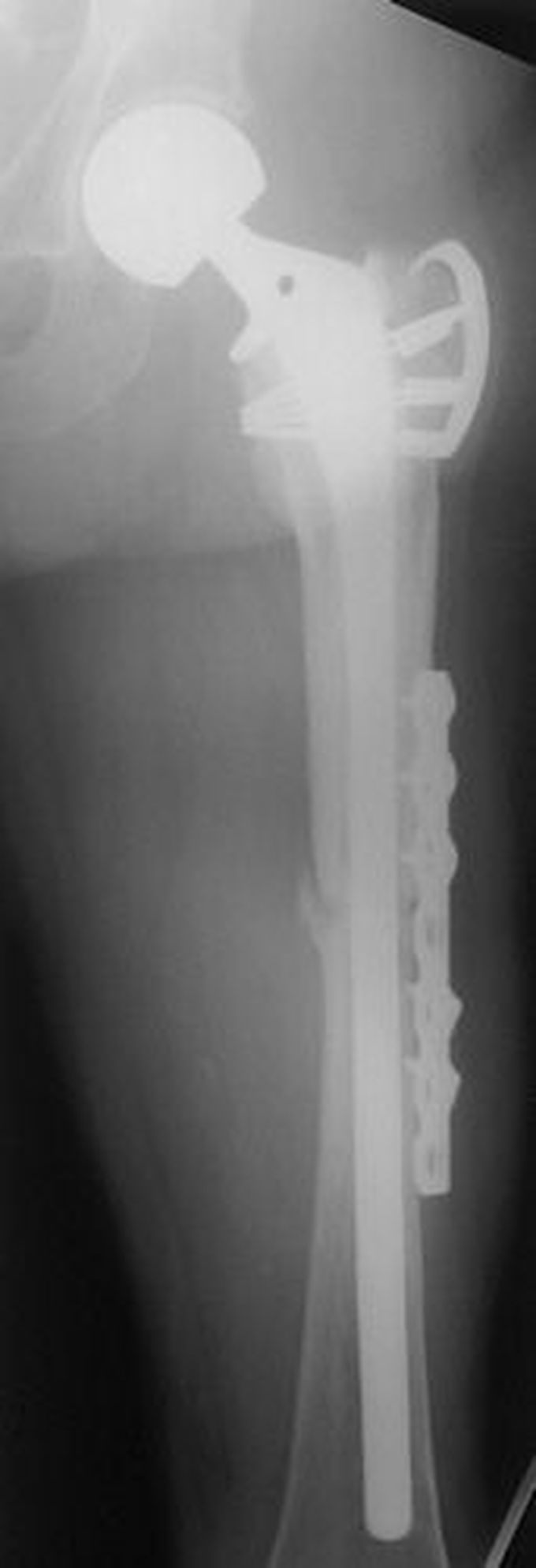 Post OP rod fixation surgery Radiograph