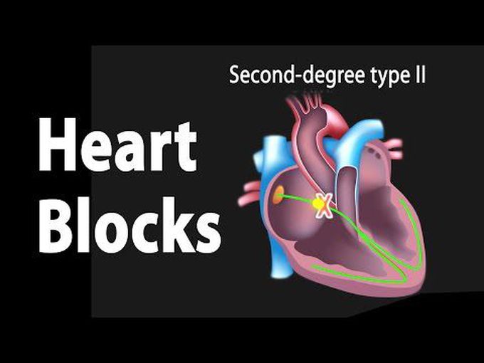 Heart Blocks: AV block pathophysiology