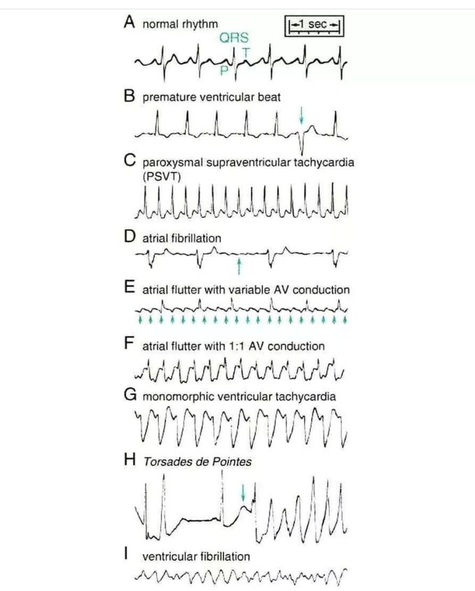 Normal Vs Abnormal Sinus Rhythm