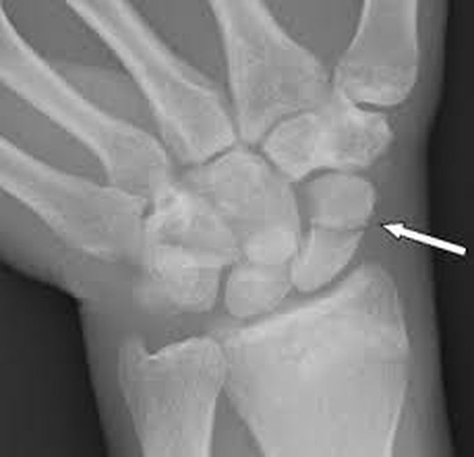 Scaphoid Fracture