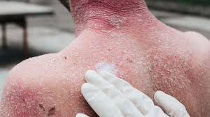 Erytherodermic psoriasis