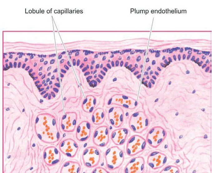 Capillary haemangioma of the skin