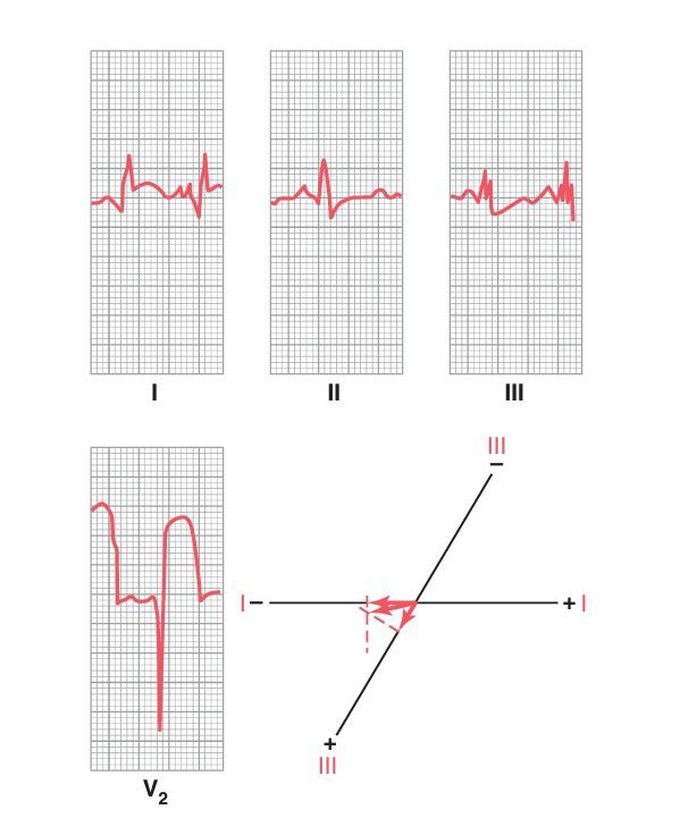 Anterior wall infarction