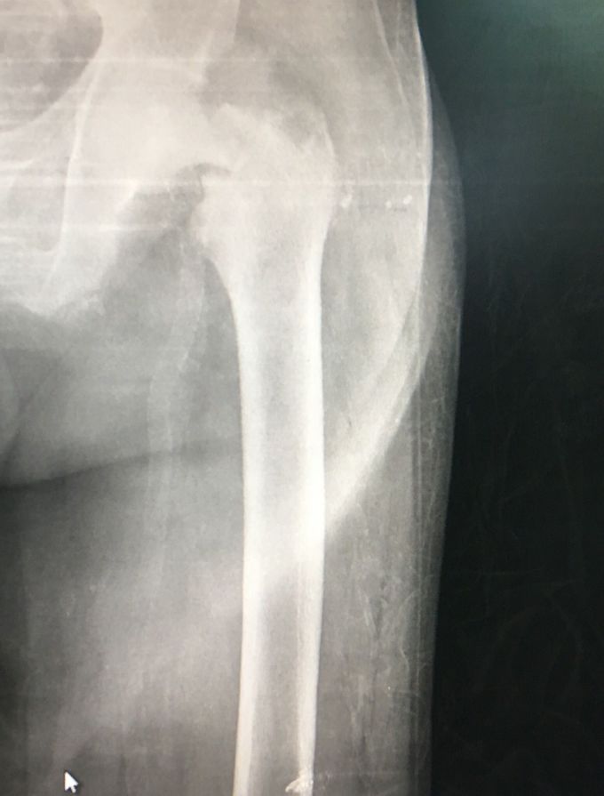 Hip x Ray