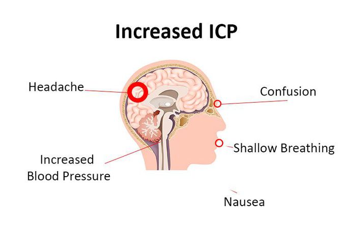 What causes increased ICP 😱
