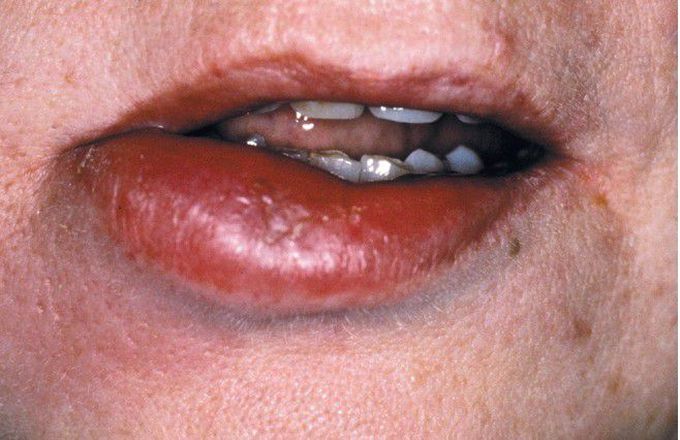 Orofacial Granulomatosis (Melkersson-Rosenthal Syndrome).