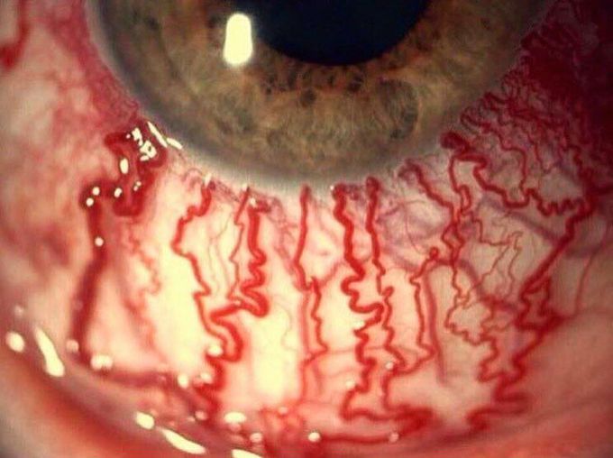 Cool photograph of a bloodshot eye!  