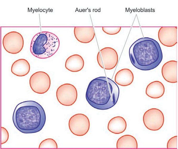 Acute myeloblastic leukaemia (AML).