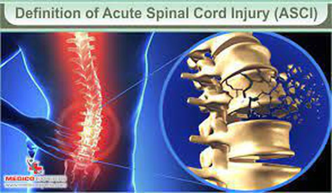 What causes an acute spinal cord injury?