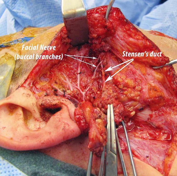 Parotid gland surgery