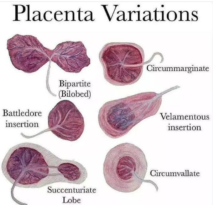 Placenta Variations