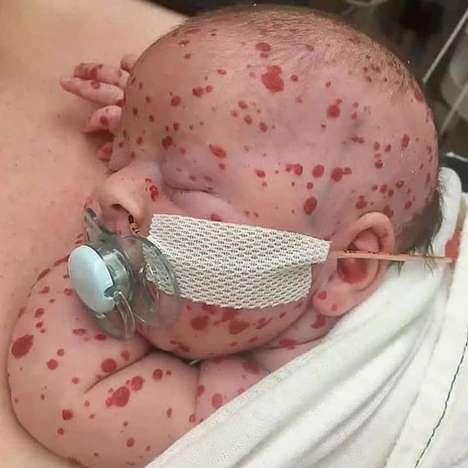 Multiple hemangiomas