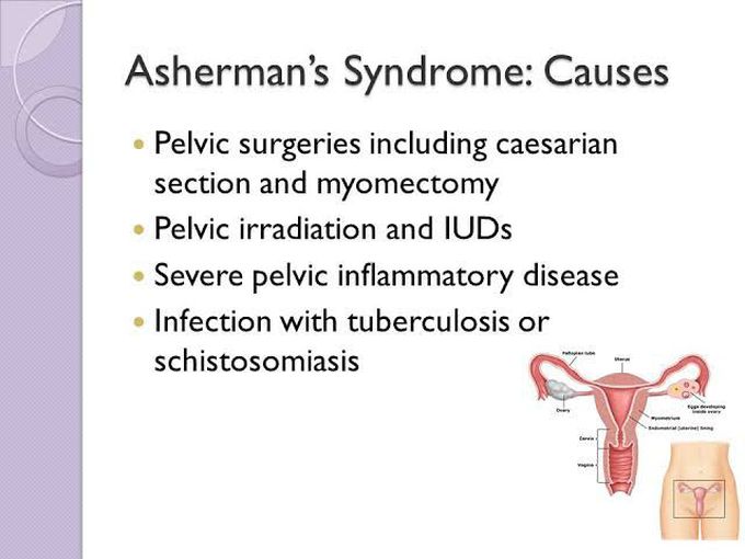 These are the main causes of Asherman syndrome