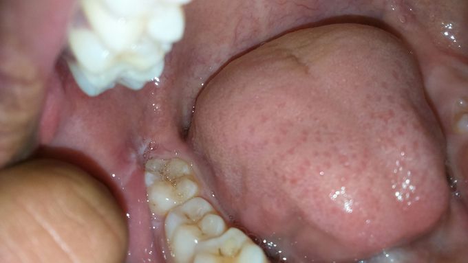 Oral problem