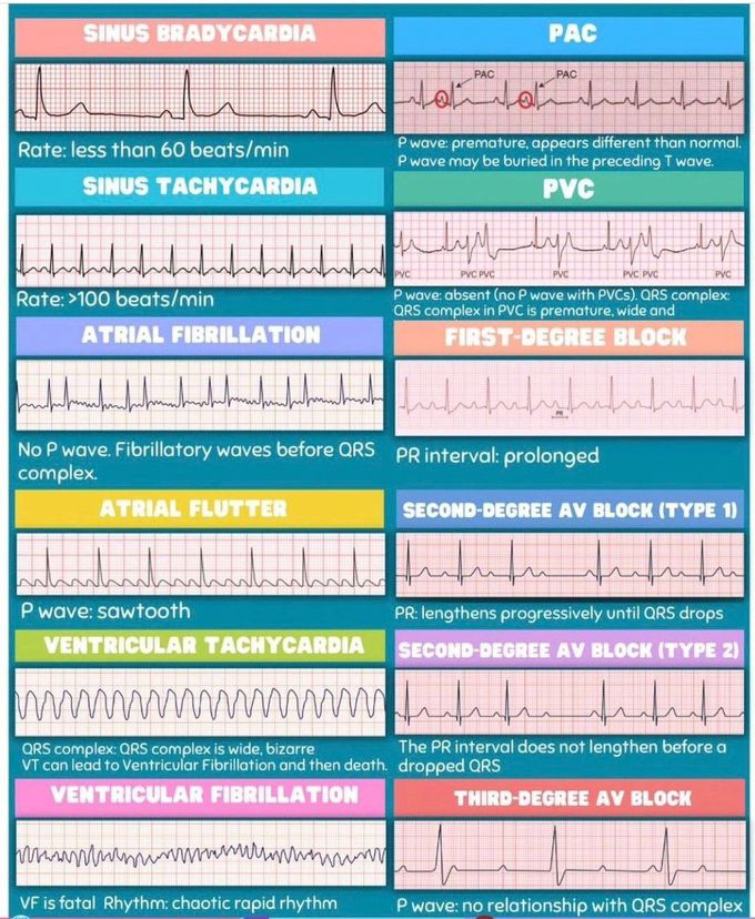 Sinus Bradycardia Vs PAC - MEDizzy