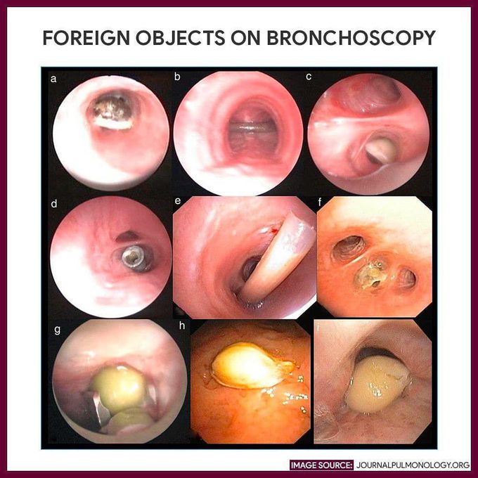 Foreign objects on bronchoscopy!.