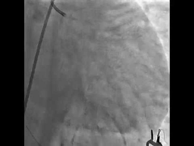 Cocaine-Induced Coronary-Artery Vasospasm