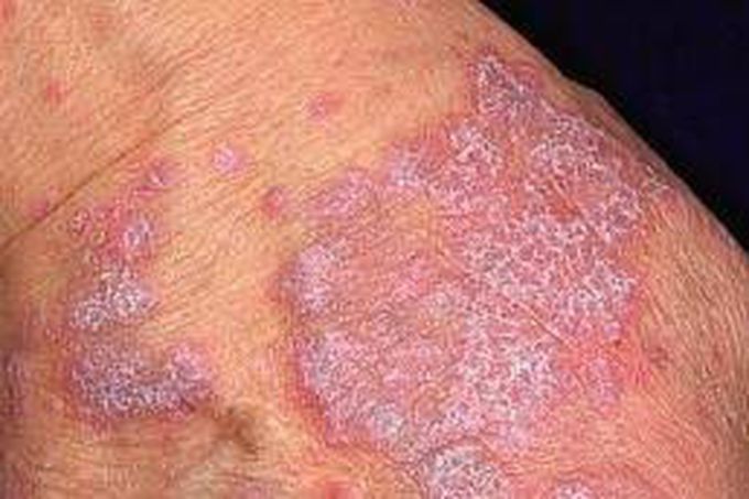 Lichen planus