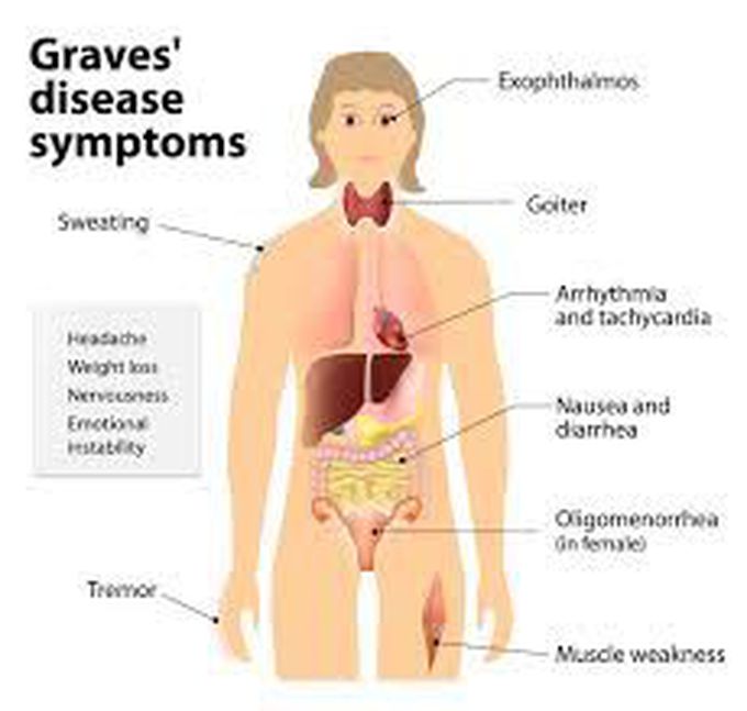 Graves disease symptoms