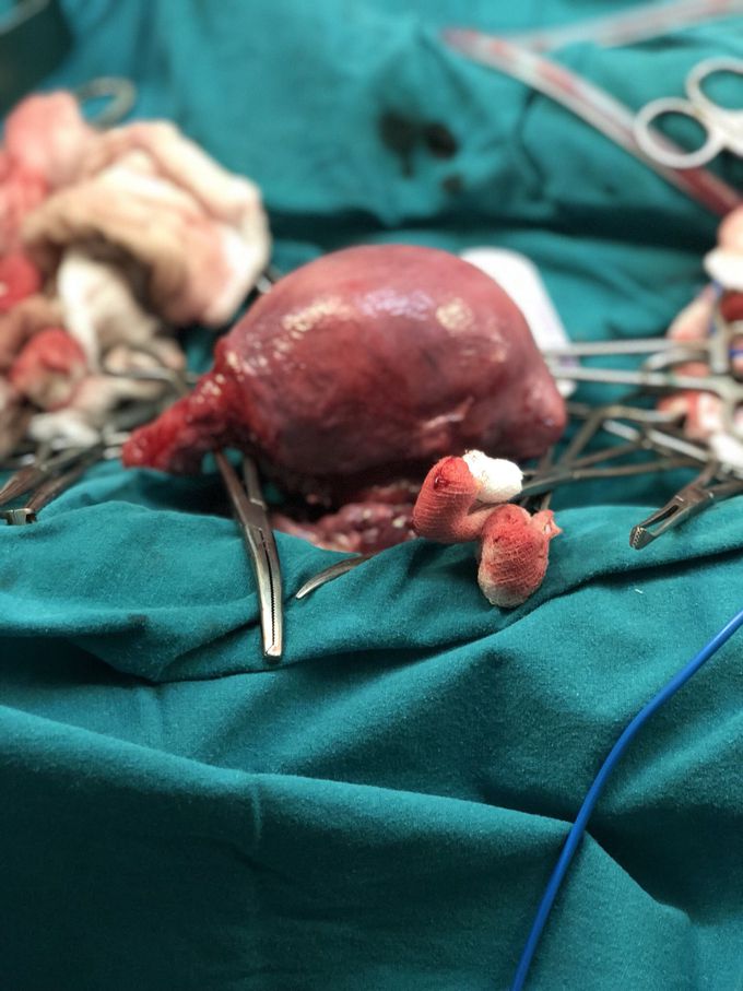 Hysterectomy
