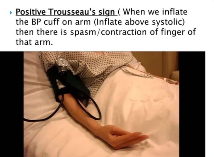 Trousseau Sign