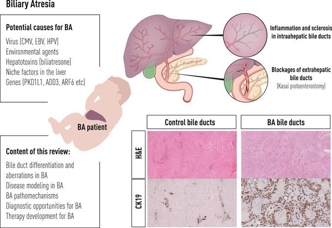 Biliary atresia diagnose