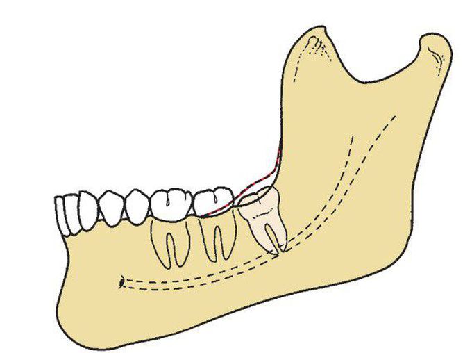 Bony impaction