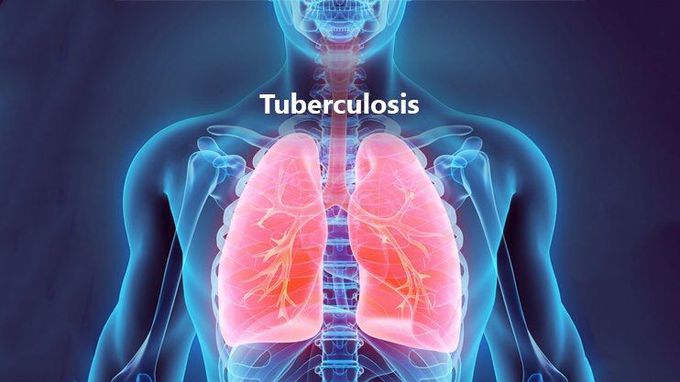 Tuberculosis Types

A TB infection doesn’t always mean you’ll get sick. There are two forms of the disease:

Latent TB. You have the germs in your body, but your immune system keeps them from spreading. You don’t have any symptoms, and you’re not contagious. But the infection is still alive and can one day become active. If you’re at high risk for re-activation -- for instance, if you have HIV, you had an infection in the past 2 years, your chest X-ray is unusual, or your immune system is weakened -- your doctor will give you medications to prevent active TB.  
Active TB. The germs multiply and make you sick. You can spread the disease to others. Ninety percent of active cases in adults come from a latent TB infection