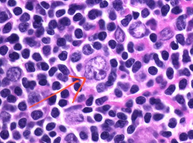 What kind of cell you can see? In which disease we can find it?