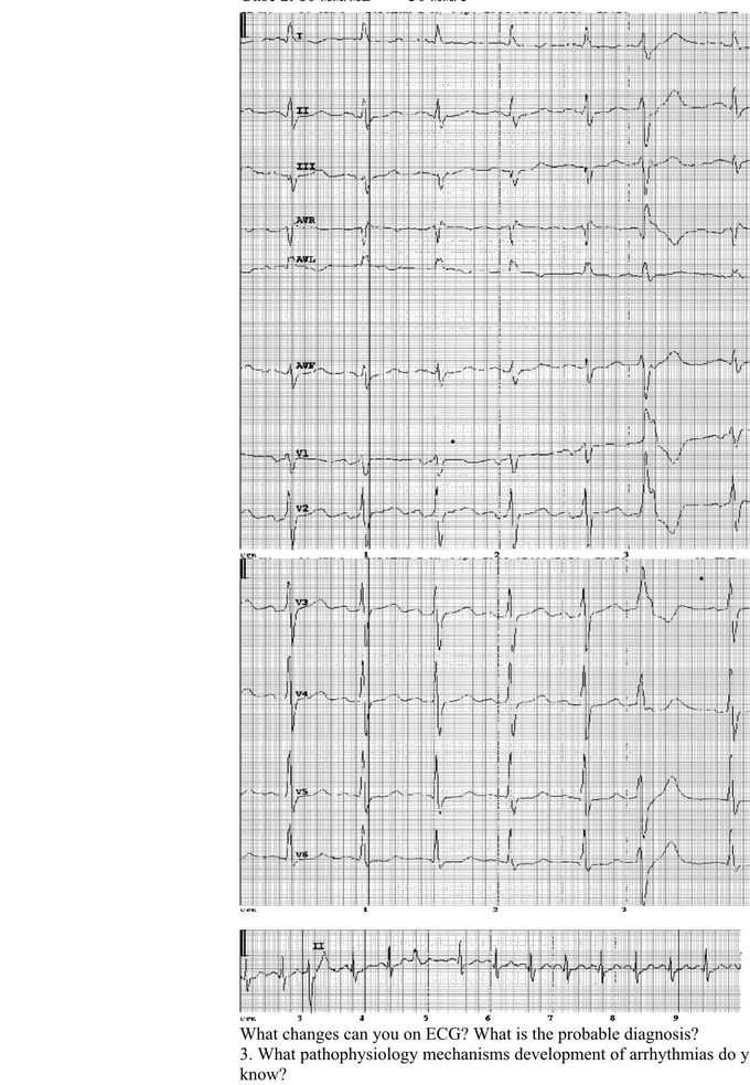 What changes can you on ECG? What is the probable diagnosis?
3. What pathophysiology mechanisms development of arrhythmias do you know?