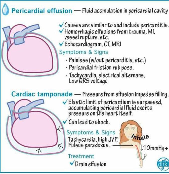Pericardial effusion and Cardiac tamponade