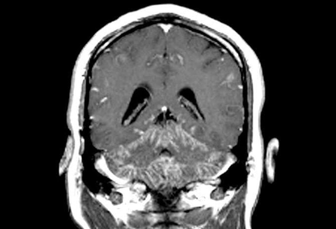 Neurosarcoidosis