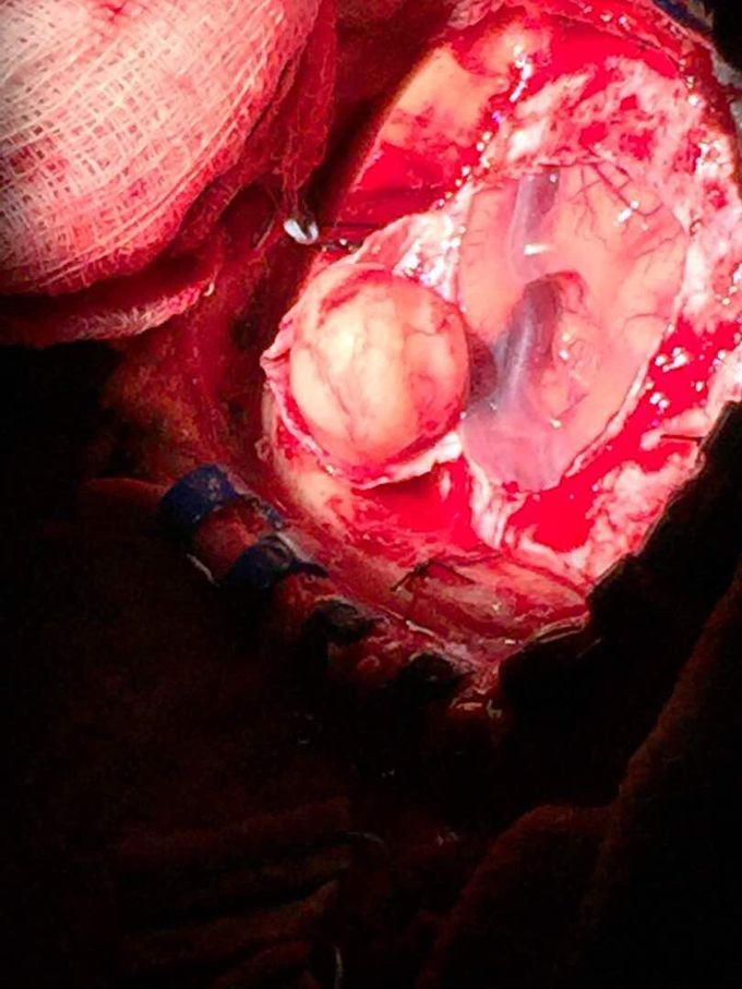 Brain surgery