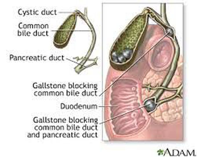 Causes of choledocholithiasis