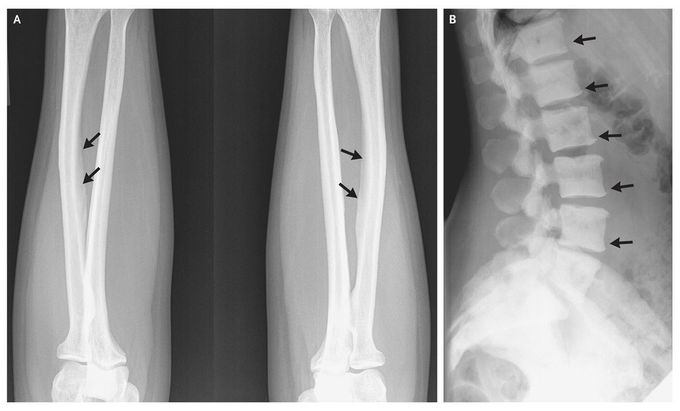 Skeletal Fluorosis Due to Excessive Tea Drinking