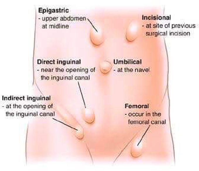 Types and location of hernia.