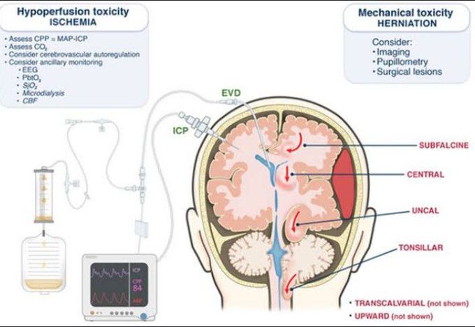 Treatment for Increased intracranial pressure