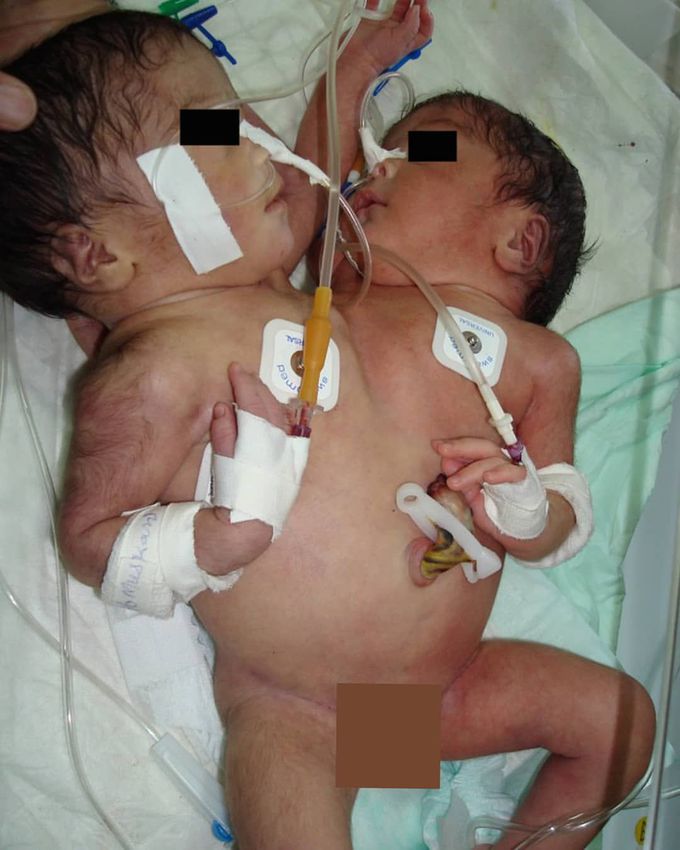 Conjoined twins - identical twins joined in utero. An extremely rare phenomenon! 