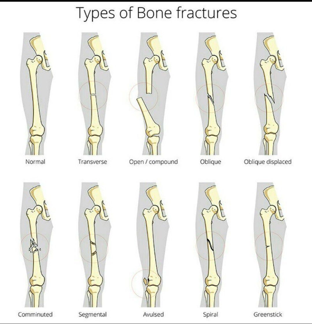 Vant til Far reparere Different types of bone fracture - MEDizzy