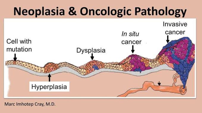 Neoplasia Progression